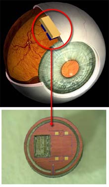 glaucoma-sensor.jpg